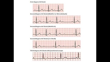 ECG course: AV blocks, Dr. Sherif Altoukhy