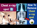 How to remove chest xray spot   qvc medical  3 galtiyon ki wajah se fail ho jate ho 