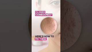 Closed Comedones? How Salicylic Acid, Retinol & Azelaic Acid Help