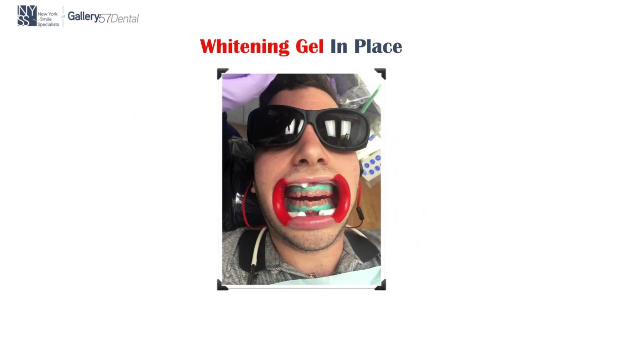 Teeth Whitening with KoR Gel at Gallery 57 Dental YouTube