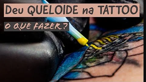 O que é bom para tirar queloide da tatuagem?