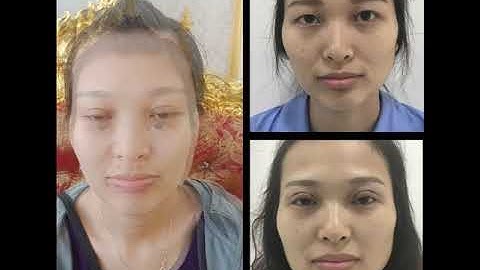 Cắt mí mini deep được 7 Ngày   cắt mí mini deep được bao lâu