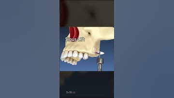 Sinus Lift Surgery: 3D Animation