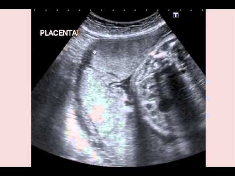 Obstetric U/S 4 - breech, placenta previa - YouTube