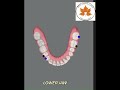 Invisalign Aligners treatment simulation