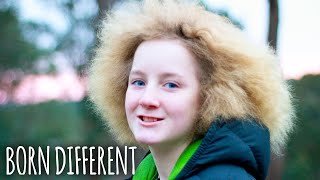 Uncombable hair syndrome Condition gives girl unruly mane