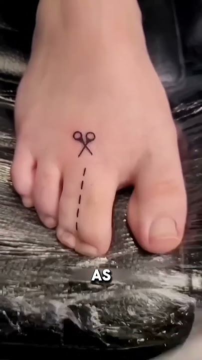 What is Syndactyly? #shorts