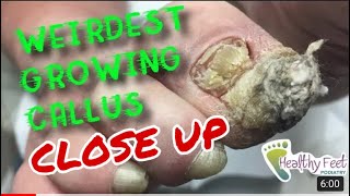 Close Up Look At The Weirdest Growing Callus