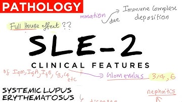 Systemic Lupus Erythematosus (SLE),PART 2, Clinical features- NEET ,USMLE ,University Examinations