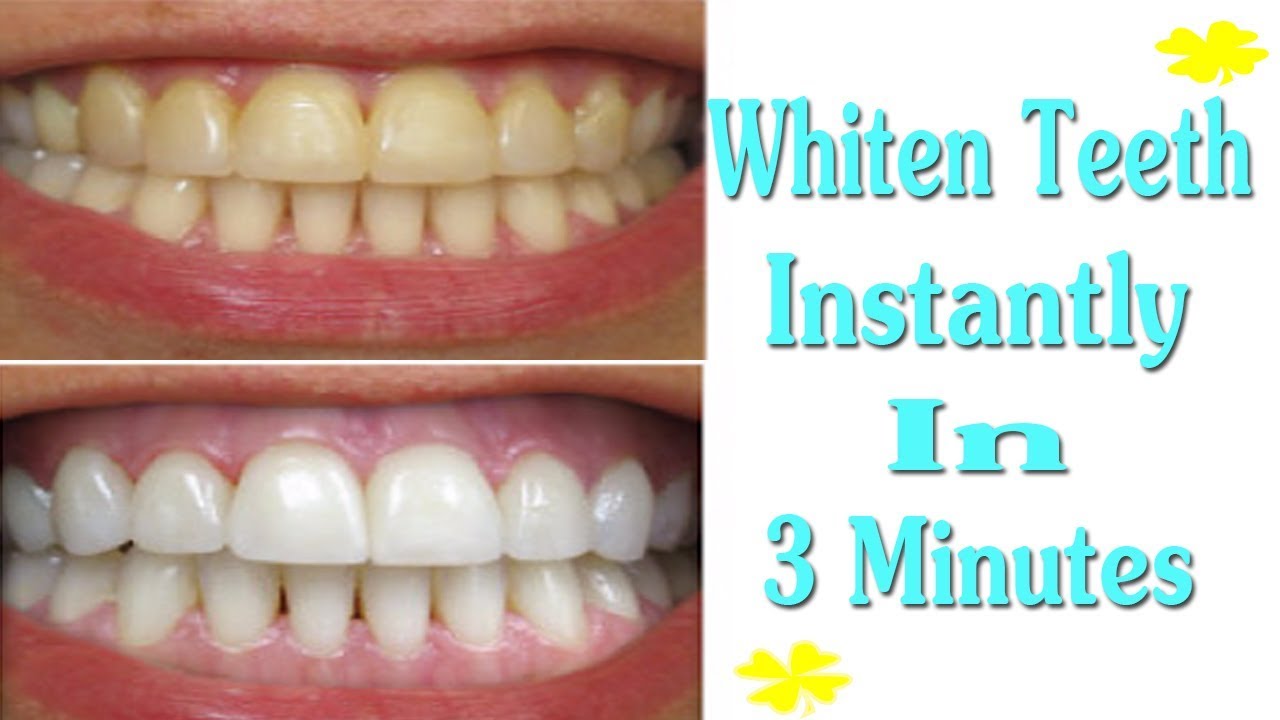 Whiten Your Teeth Instantly In 3 Minutes You Should Know Healthy