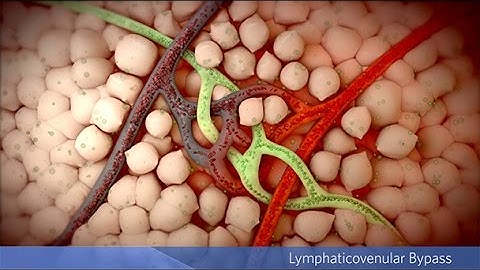 Lymphedema Surgery: Lymphaticovenular Bypass
