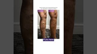 What happens if I don't get my veins treated?