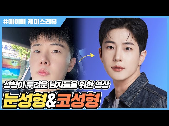 [남자성형전후] 에이비케이스리뷰🎬 콧대성형만 했더니 결국..  코재수술 성공후기