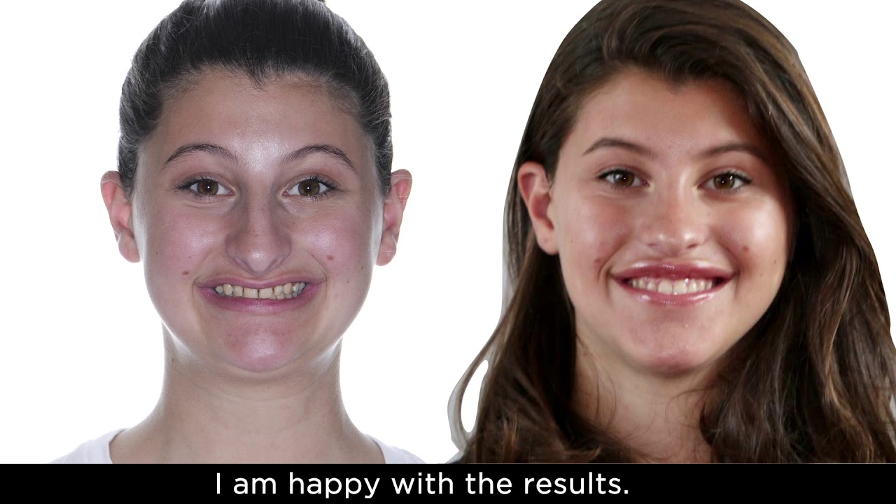 ARIELA: Class II, Short face, Nasal hypertrophy - Bimaxillary advancement, Mentoplasty, Rhinoplasty