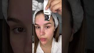 Как избавиться от черных точек 🩶 Аппарат для уз чистки