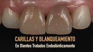 Carillas y blanqueamiento en dientes tratados endodónticamente