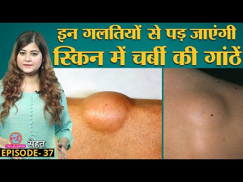 क्या होता है Lipoma जिसमें skin के अंदर चर्बी की गांठ बन जाती है? जाने इलाज के तरीके | Sehat Ep 37