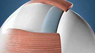 Scleral Buckle  Overview