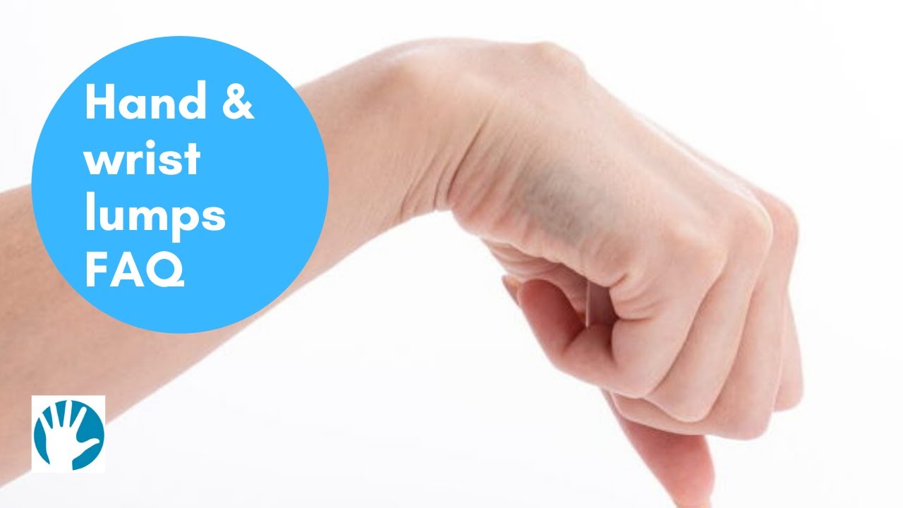Hand and wrist lumps FAQ - Midland Hand Clinic - YouTube