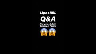 Lipo+BBL Q&A after going with Baltic Surgery Tijuana