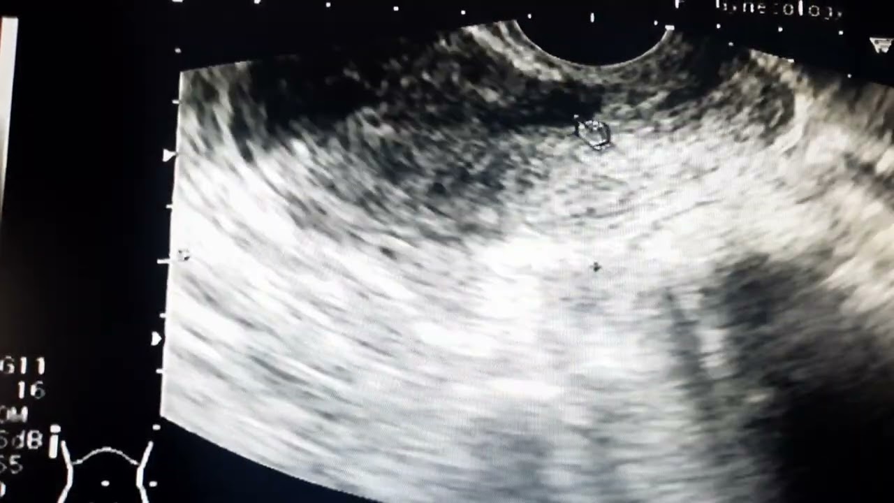 القيلة البرزخيّة أو ال Isthmocele