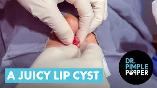 A JUICY LIP CYST