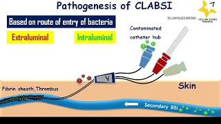 CLABSI Central line related bloodstream infection CLABSI Bundle Types of CVCs