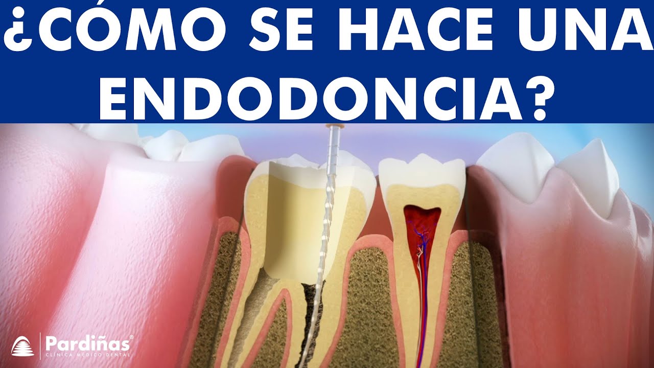 ¿Endodoncia o Extracción?