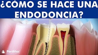 ¿Qué es una Endodoncia?  Tratamiento de conductos o desvitalización del diente paso a paso ©