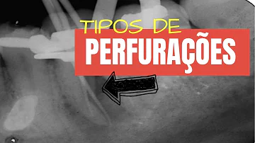 O que fazer quando perfura o canal?