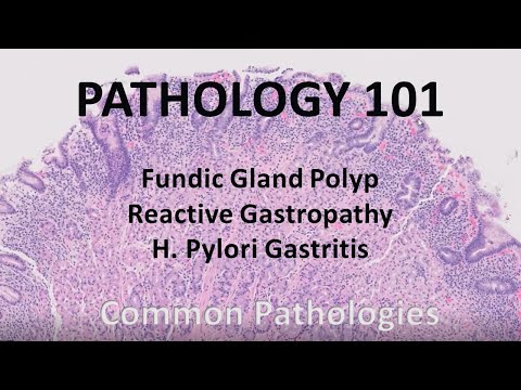 Fundic Gland Polyp, Reactive Gastropathy, and H. Pylori gastritis | Pathology 101