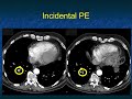 Missed Diagnosis in Body CT: Pearls and Pitfalls 2023 - Part 3