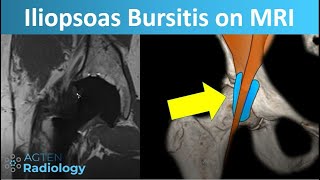 MRI of the iliopsoas bursitis and its pitfalls screenshot 3