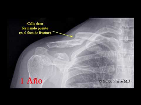 Fractura de Clavícula