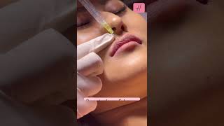Improved Lip Shape By Fillers Live Procedure 