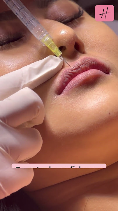 💋Improved Lip Shape by Fillers Live Procedure | #shorts #shortsfeed #lipfiller