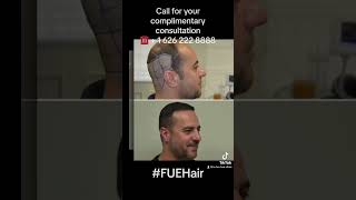 Before After FUE Hair Restoration Complete scalp FUE Restoration all 4 zones, Los Angeles California