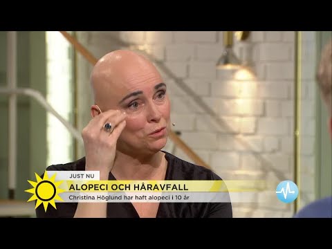 Video: Androgen Alopeci Hos Män Och Kvinnor - Orsaker, Behandling