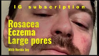 Learn how to treat rosacea successfully- IG subscription by Nerida Joy 3,514 views 10 months ago 12 minutes, 24 seconds