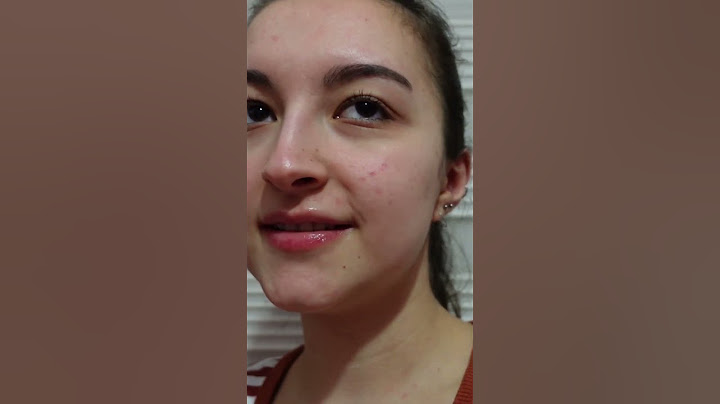 1 yıllık Akne tedavimin özeti #shorts #akne #sivilce #roaccutane #sivilcetedavisi