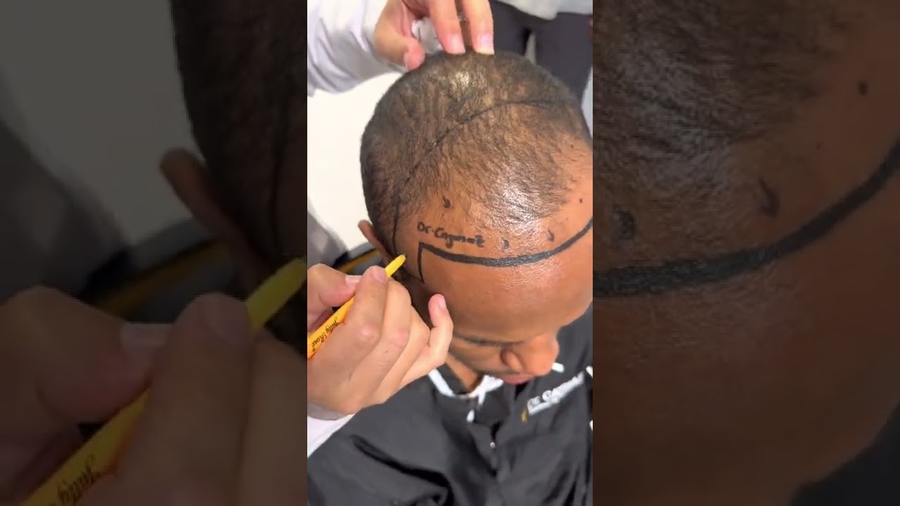 Beard Line Designing by Medical Doctor