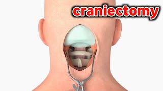 شاهد كيف يتم ازالة جزء من الدماغ_craniectomy surgery
