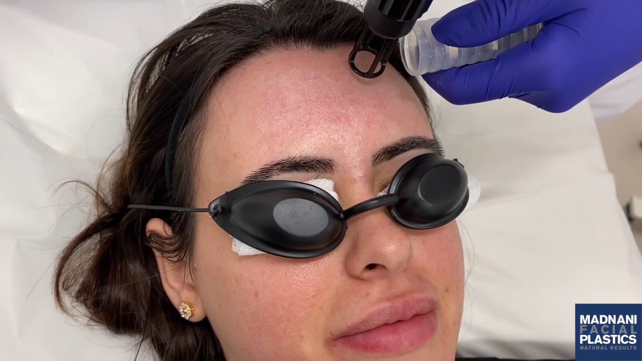 Erbium Laser Resurfacing Treatment YouTube Erbium Laser Resurfacing Treatment YouTube