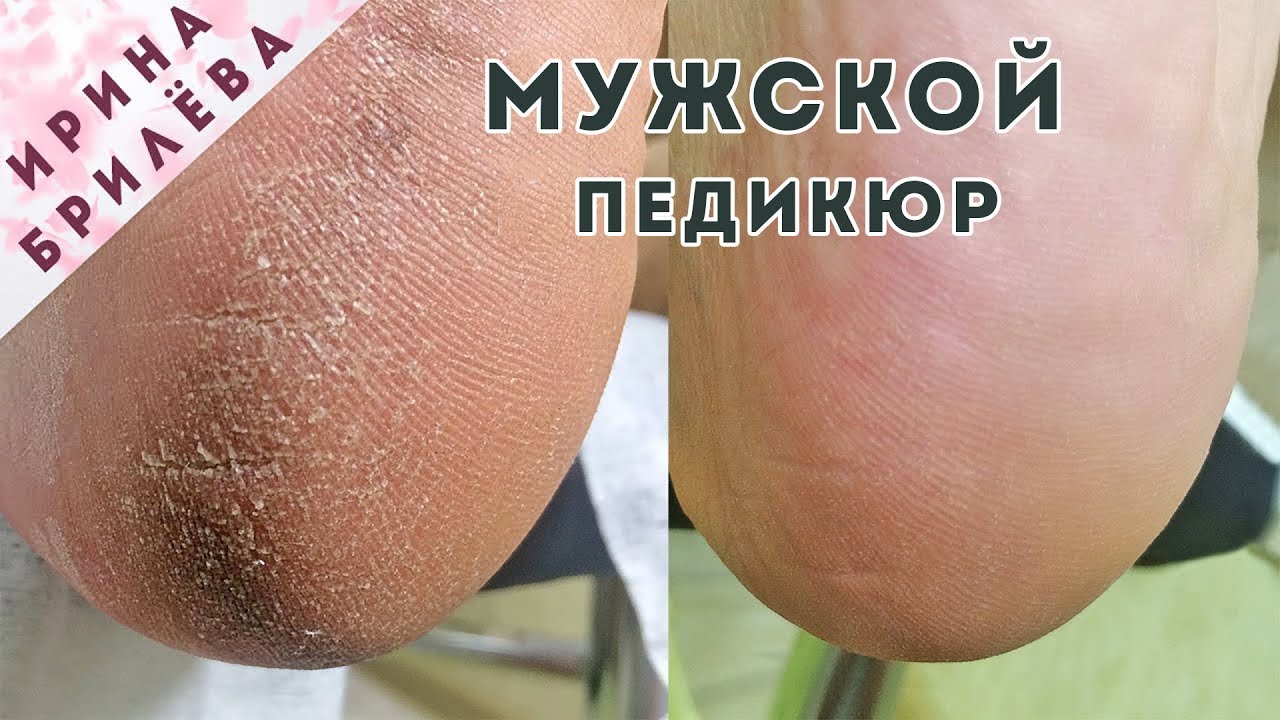 МУЖСКОЙ педикюр 🌸 Аппаратное УДАЛЕНИЕ ТРЕЩИН