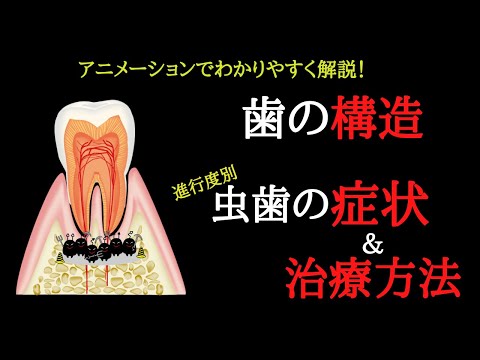 歯の構造とむし歯（進行度別）の治療方法・症状