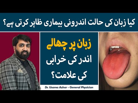 Causes And Treatment Of Mouth Ulcer | Munh Ke Chhalon Ki Wajah Aur Asaan Ilaj