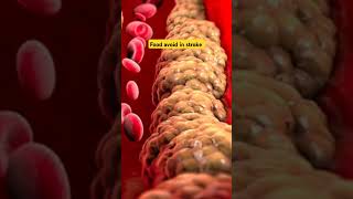 Falij Ka Ilaj Or Khurak