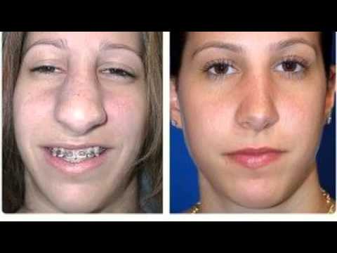 free nose plastic surgery cost