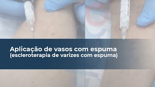 Endovascular vascular cirurgia escleroterapia vs