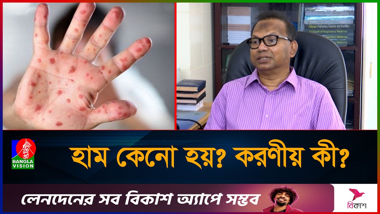 কীভাবে বুঝবেন শিশু হামে আক্রান্ত!